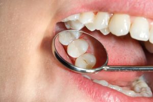 dental implant care